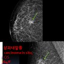 유방_상피내암종(carcinoma in situ, CIS) 64/F 이미지