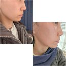 닥터송제통의원 | 대전 피부과에서 V라인 되찾은 올타이트리프팅 찐후기-키닥터원장님