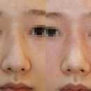 닥터로미성형외과의원 | 휜코 교정과 매부리코 교정, 무보형물로 숨길까지 시원하게 해결했어요! (4개월 차 후기)