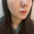 송도 오블리브의원 통증 없는 쿨소닉 리프팅 3000샷 내돈내산 리얼후기