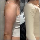 멍편한세상 | 팔지방흡입 후 당일~2일차 리얼 후기 | 압박복 멍 붓기 통증 솔직 기록