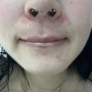 입주위 피부염(지루성피부염 + 주사 피부염) 극복기 아마도 완치 ?!