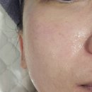 청심로 | 피부관리 잘하는 곳 [메디스킨 유리하] 칵테일필 저온 플라즈마로 블랙헤드 화이트헤드 피지 제거 후기