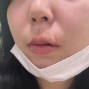 신비성형외과의원 | (4) 입술,인중 개물림 흉터치료 내돈내산 여정 (울산/부산)