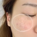 양산 | 양산기미제거 양산잡티제거 양산멜라쥬 후기 아베르뷰티