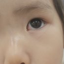 눈사랑성모안과의원 | 아기눈 흰자에 물집? 수포? 알레르기성 결막염 대전 눈사랑성모안과 _2025/06/02