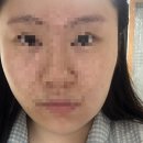 준약국 | [사랑니전문치과, 매복사랑니발치]수성사랑니치과 + 발치후기
