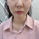 강남뷰티업성형외과의원 | 후기] 신사역 인모드 잘하는 곳 나아성형외과의원 인모드 시술 솔직 후기(위치, 진료시간, 효과, 통증, 멍)