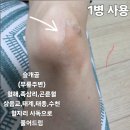 완산-62 | 전주 완산구 하지정맥류 고객님 관리 후기!