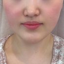 노바의원 | 당감동피부관리 ‘미샤인뷰티' 작은얼굴 윤곽관리 후기