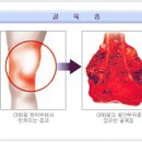 골육종암, 골육종 증상 (뼈암 증상) 이미지