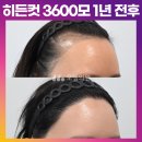 [20대 여자 넓은 M자 헤어라인 두피문신 후 모발이식] 비절개 히든컷 3600모 1년 후기 (모엠의원/헤어라인/전지훈원장) 이미지
