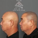 채도스칼프 | 50대 탈모 삭발모근표현 27년차 화가 손끝 자연스런 두피 헤어라인 구현 강남 강서 마포