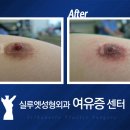 유두의 크기를 줄이는 수술 유두축소 이미지