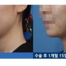 [엔슬림 얼굴지방흡입후기] 1개월 후 전후 사진! 이미지