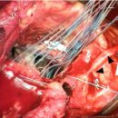 Aortic root replacement after previous surgical intervention on the aortic valve, aortic root, or ascending aorta 이미지