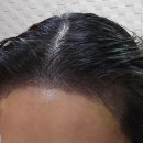 파티락 | [여성 비절개 헤어라인 모발이식] 수술 10일차 후기 (w.각질파티,이식모탈락)