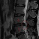 허리 디스크 mri 사진입니다 이미지