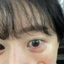 온도성형외과 애교살반영구 내돈내산 1년차 솔직후기 l 리터치 두번이나 받은 썰