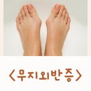 수무지옆들 | 무지외반증 교정 교정기 수술 수술후기 신발 운동화 패치 깔창 알아봐요