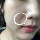 처진 얼굴 탄력 올려주는 신사동 올타이트 리프팅 후기