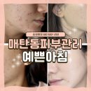 경기도 수원시 영통구 매탄로 매탄로79번길 | 내돈내산리뷰 매탄동피부관리 [예쁜아침]에서 트러블관리 받은 솔직후기
