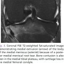 meniscal tear and mri 이미지