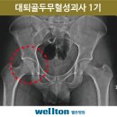 고관절인공관절수술후 올 수 있는 합병증 이미지