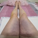 신사 지방추출주사 후기 허벅지 지팻주사 한 달 후 변화 솔직후기