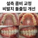 부경에스치과의원 | 송파 교정치과 설측교정. 돌출입 발치 없이 비발치 전체 후방이동으로 개선한 콤비교정
