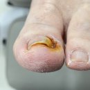 파주내성발톱과 발톱무좀 닥터페디&amp;네일투게더에서 1:1맞춤 케어
