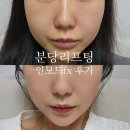 ㈜분당제일에너지 | 분당리프팅 서현리프팅 인모드fx 풀페이스 2주차 효과 가격