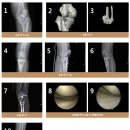 홍익병원 환자 치료 증례 - 관절센터 서영래 센터장 이미지