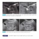 유문협착증 (Hypertrophic pyloric stenosis) 이미지