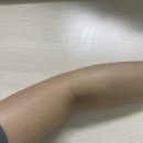 일광약국 | 일광화상 피부관리법｜수분크림으론 부족해서 화상 연고 사용한 후기