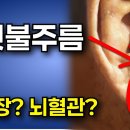 귓불주름 심장? 뇌혈관? 이미지