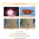담낭종괴수술후기. 김정윤 원장님께서는 배꼽 쪽 한군데만 작게 절개하여 수술을 진행하여 주셨습니다. 이미지