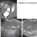 Migration of a contraceptive device 이미지