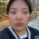 씨의원 | 노원 중계의원 점 주근깨 제거 후기｜ 제거 1주일 경과 내돈내산 리얼 후기