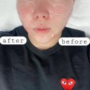 여월프라자 앞 육교 밑 | 시흥리프팅 이중턱살 제거, 슈퍼젝션 나만 알고싶은곳