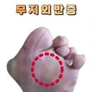 무지외 반증 이미지