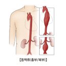 복부 대동맥류[Abdominal aortic Aneurysm]소화기질환, 순환기질환, 응급질환 이미지