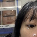 굿모닝피부과의원 | 강동구 천호역 비립종 제거 내돈내산 후기