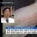 해파리 쏘임 증상 쏘였을 때 응급처치 약 연고 이미지