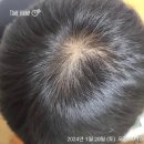 동안 | 판시딜 가격 탈모고민 남편 2년동안 복용후기