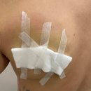 이오 | 청담다이어트 뒷날개 이오팻주사 후기