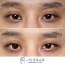 시원성형외과의원 | 자연유착쌍꺼풀, 미세지방이식 2개월차 후기 : 상안검 다발성 겹주름 및 함몰눈을 개선 at. 시원성형외과