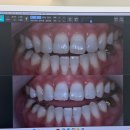 옥치과의원 | 강남역치과 에서 누런니 치아미백 효과 1회 받고 만족한 후기 (전후사진비교, 비용,방법)