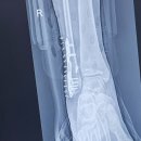 을지로정형외과의원 | 발목골절 일기 (외복사뼈 뽀각 10~18일차)