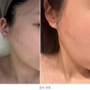 윈텀 | 강남역 문제성 피부 여드름 전문 ‘윈터에스테틱’ 좁쌀여드름 관리 후 고민 해결 후기